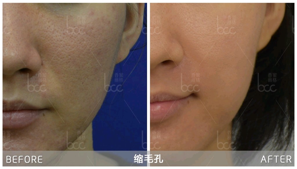 皮肤松弛毛孔大黑头多怎么办 新氧美容整形