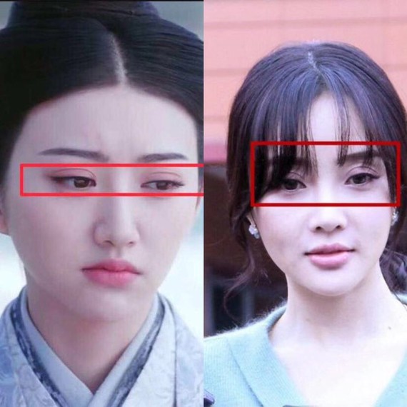 我们都知道东方人的上睑窄,眼窝平,眉弓低,上睑厚,不适宜做过宽的双