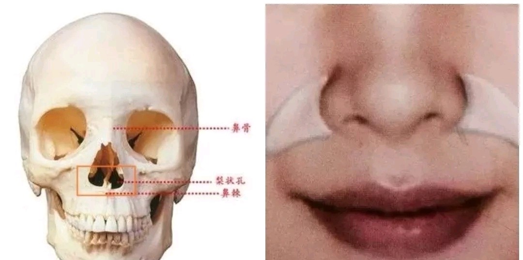 鼻基底填充位置图片