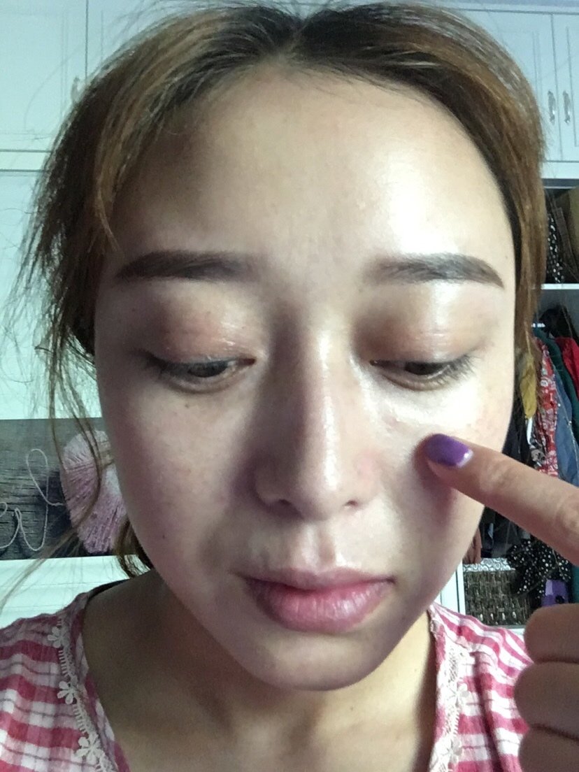 我1年前做的自体脂肪填充泪沟现在填充的部位有包块鼓起来的比没做之