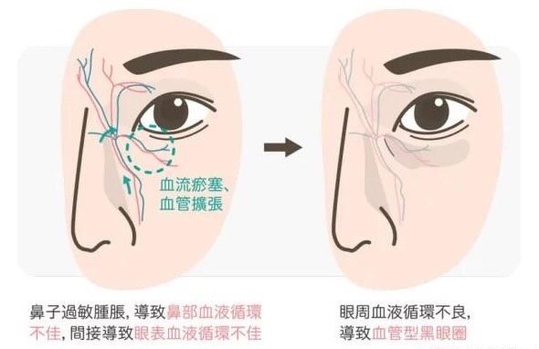 黑眼圈和眼袋有什么区别吗 从国外买了 新氧美容整形