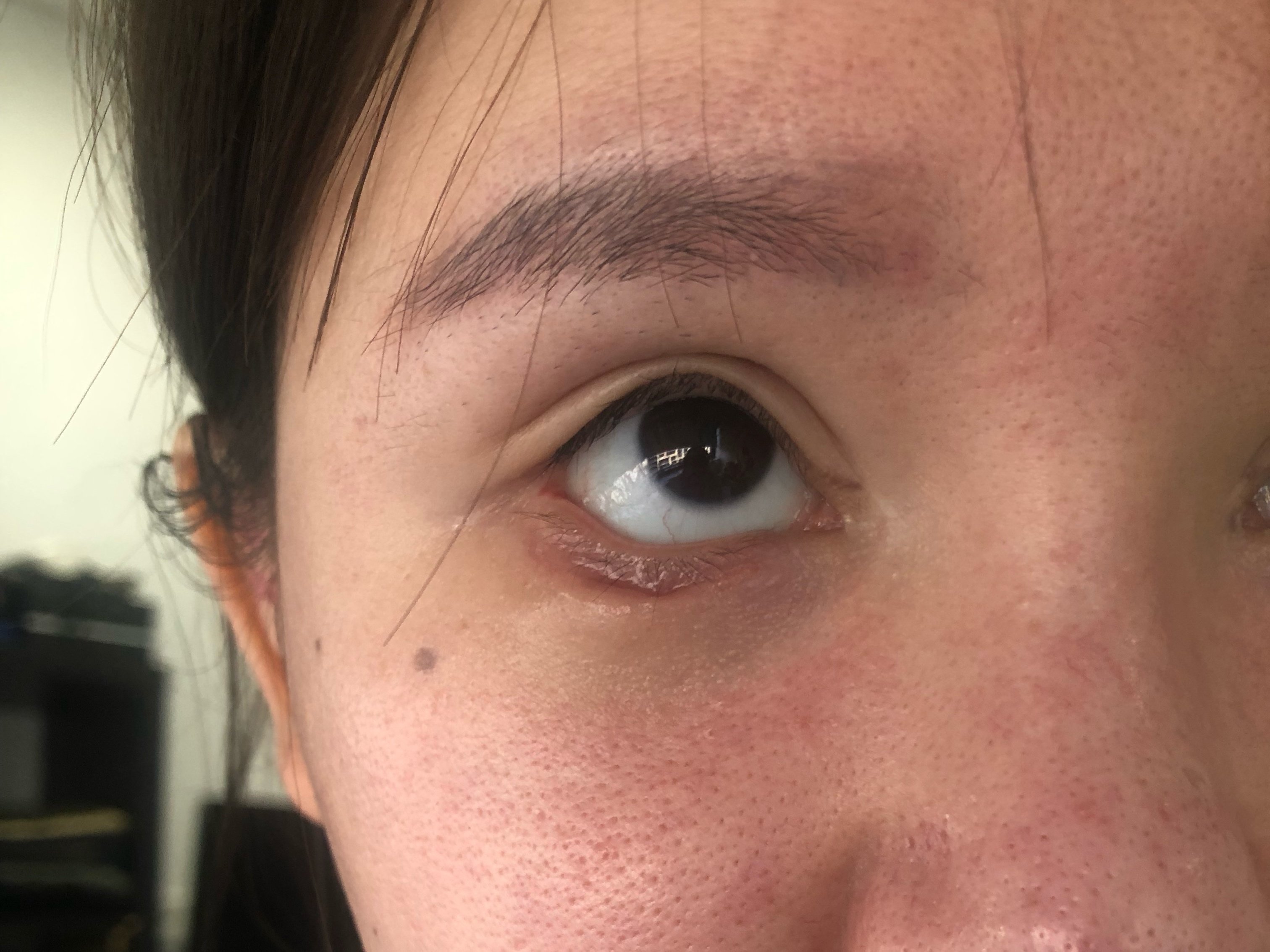外切眼下至术后四十天右眼疤痕凹陷可以恢复吗这种疤痕修复有效吗