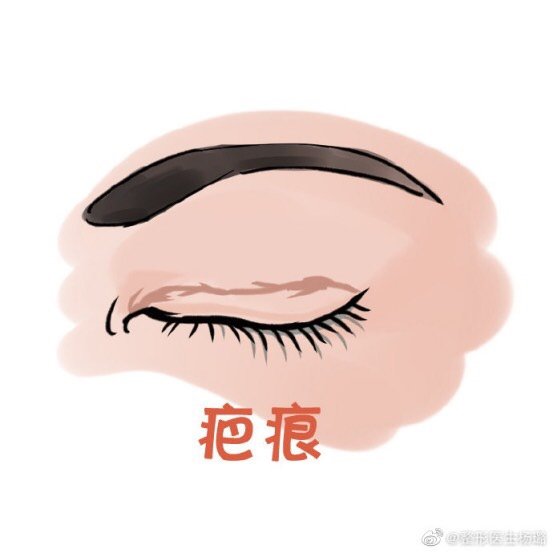 双眼皮手术失败常见的表现形式及对应的 新氧美容整形