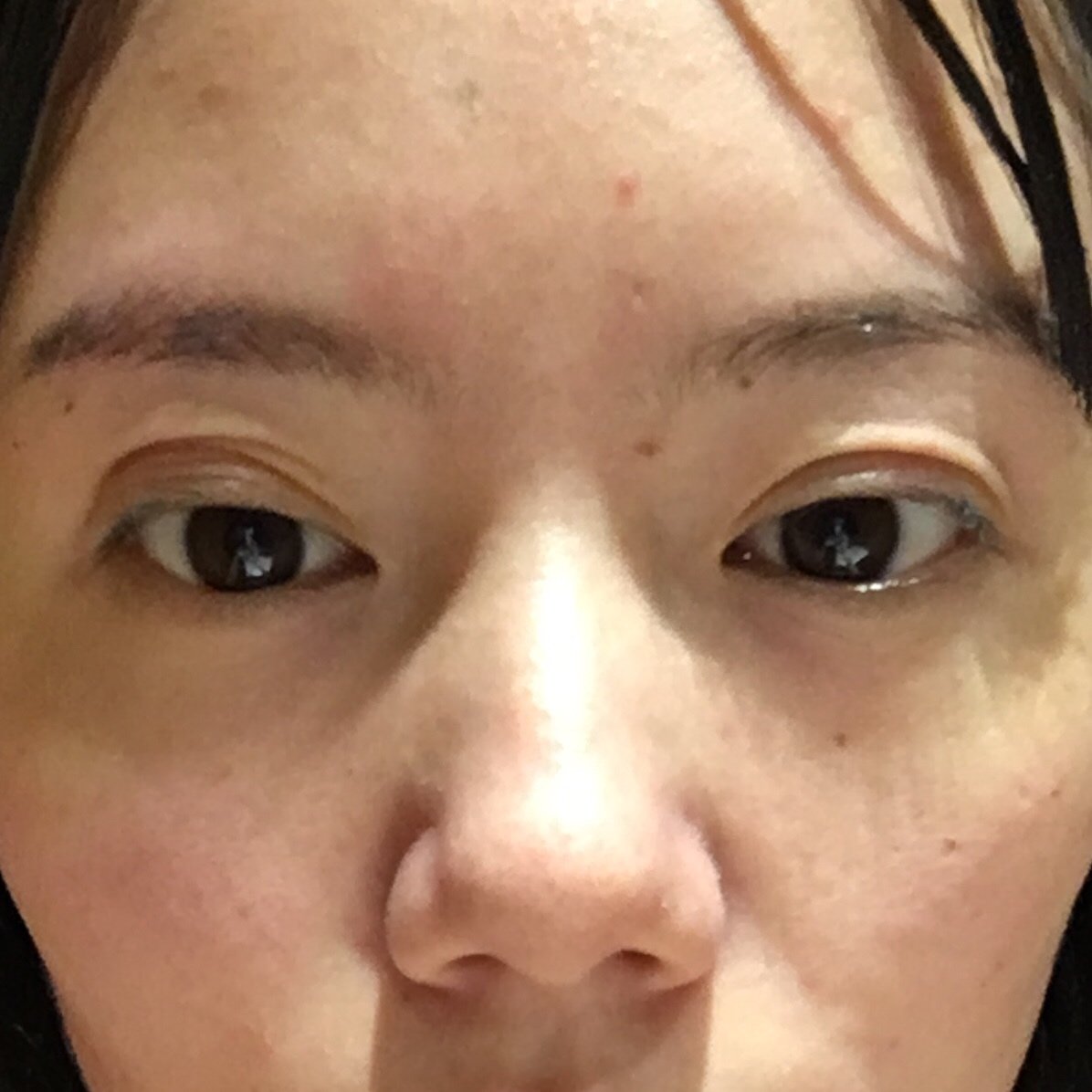双眼皮手术失败了大小眼明显出现了四眼 新氧美容整形