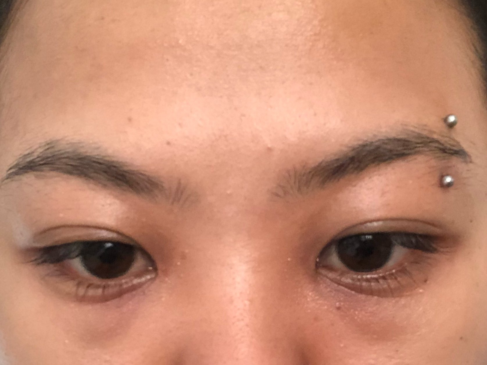 请问医生 今年23岁 长期熬夜 黑眼圈较深 我这样的眼袋适合用什么手术