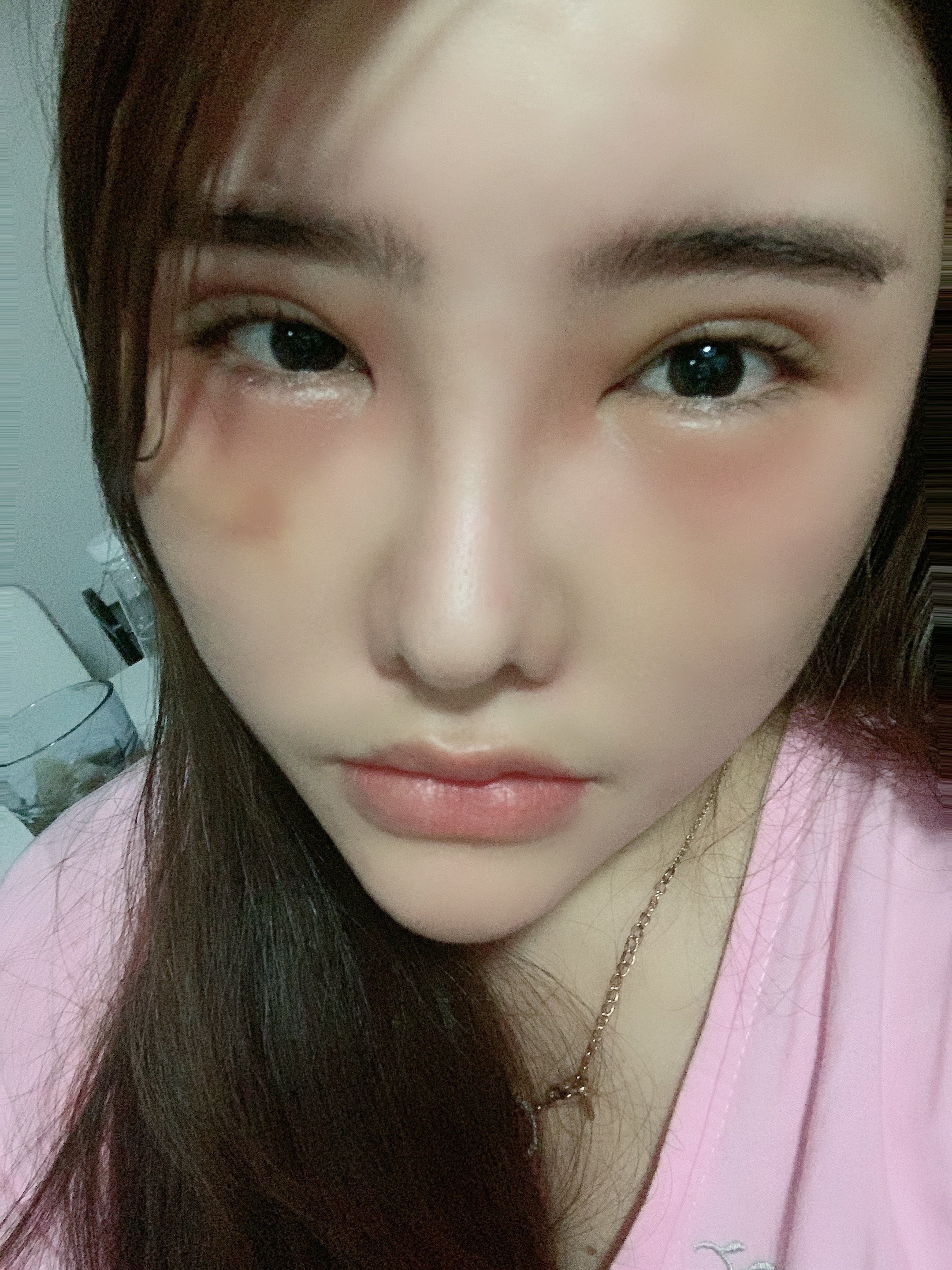 填了玻尿酸过了十天左右喝了酒之后脸就开始大肿玻尿酸排异可以打溶解