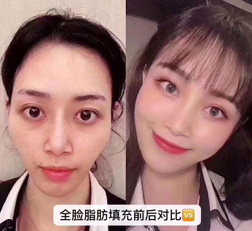 自体脂肪全脸填充一般多久适合第二次填充?