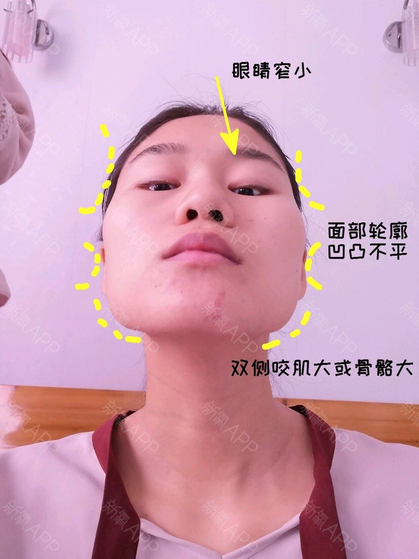 求看脸:头扁国字脸,面塌又凸嘴,能整成鞠婧祎吗?