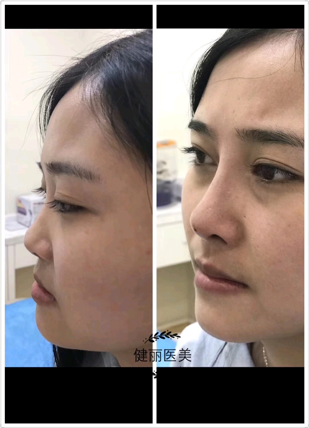 隆鼻是玻尿酸好还是假体的方式比较好?