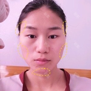 求看脸:头扁国字脸,面塌又凸嘴,能整成鞠婧祎吗?