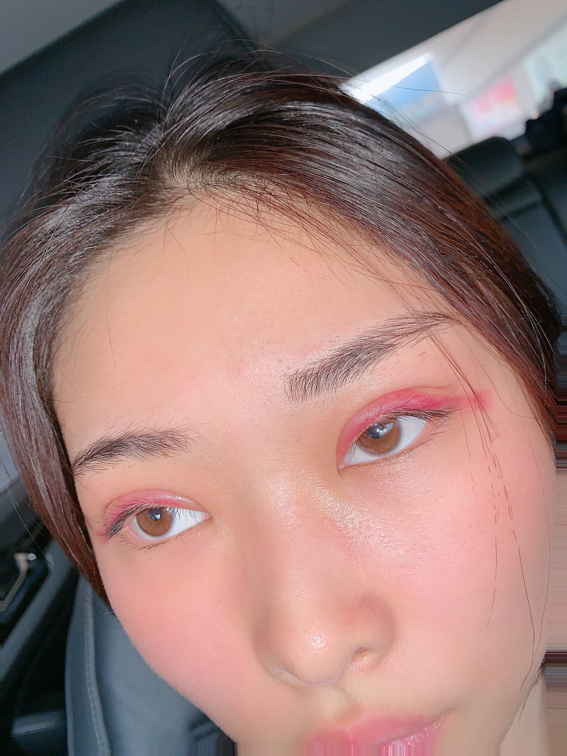 做完埋线双眼皮第二天眼睛超级红正常吗眼睛还是特别肿有在吃消炎药用
