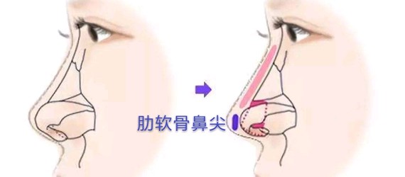 我感觉自己的鼻部基础不好 想做肋软骨 新氧美容整形