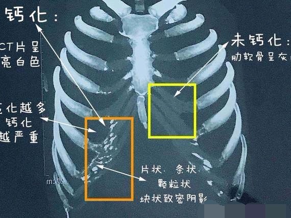 肋骨凹陷胸骨图片