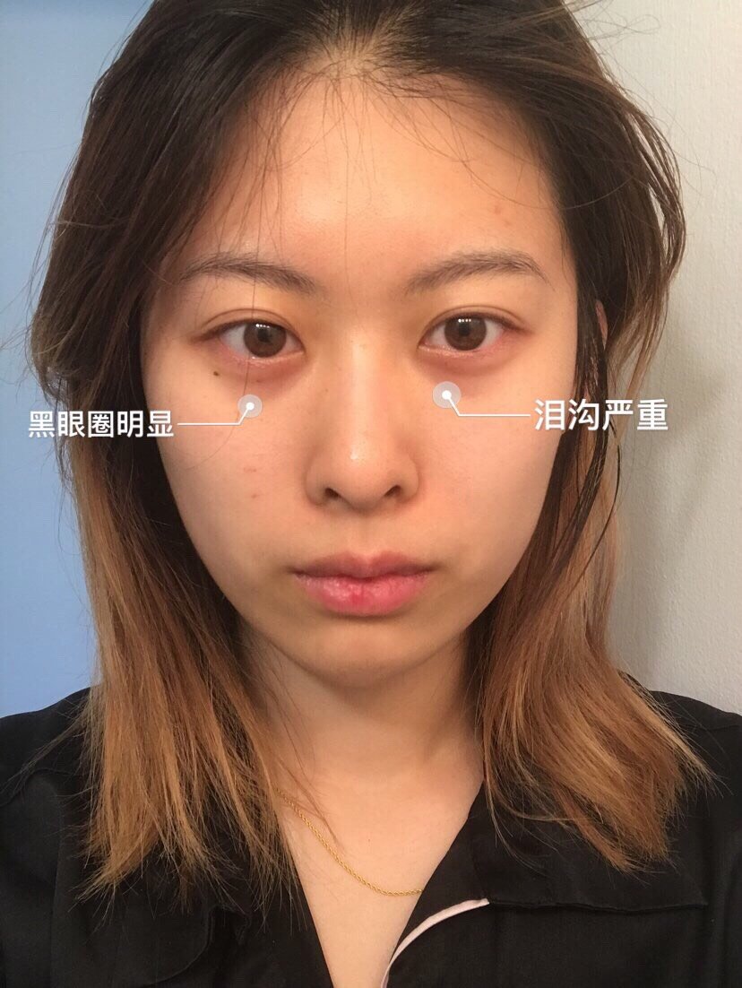 整个下颌面突出怎么办 就是侧面很难看 新氧 专业医美服务平台