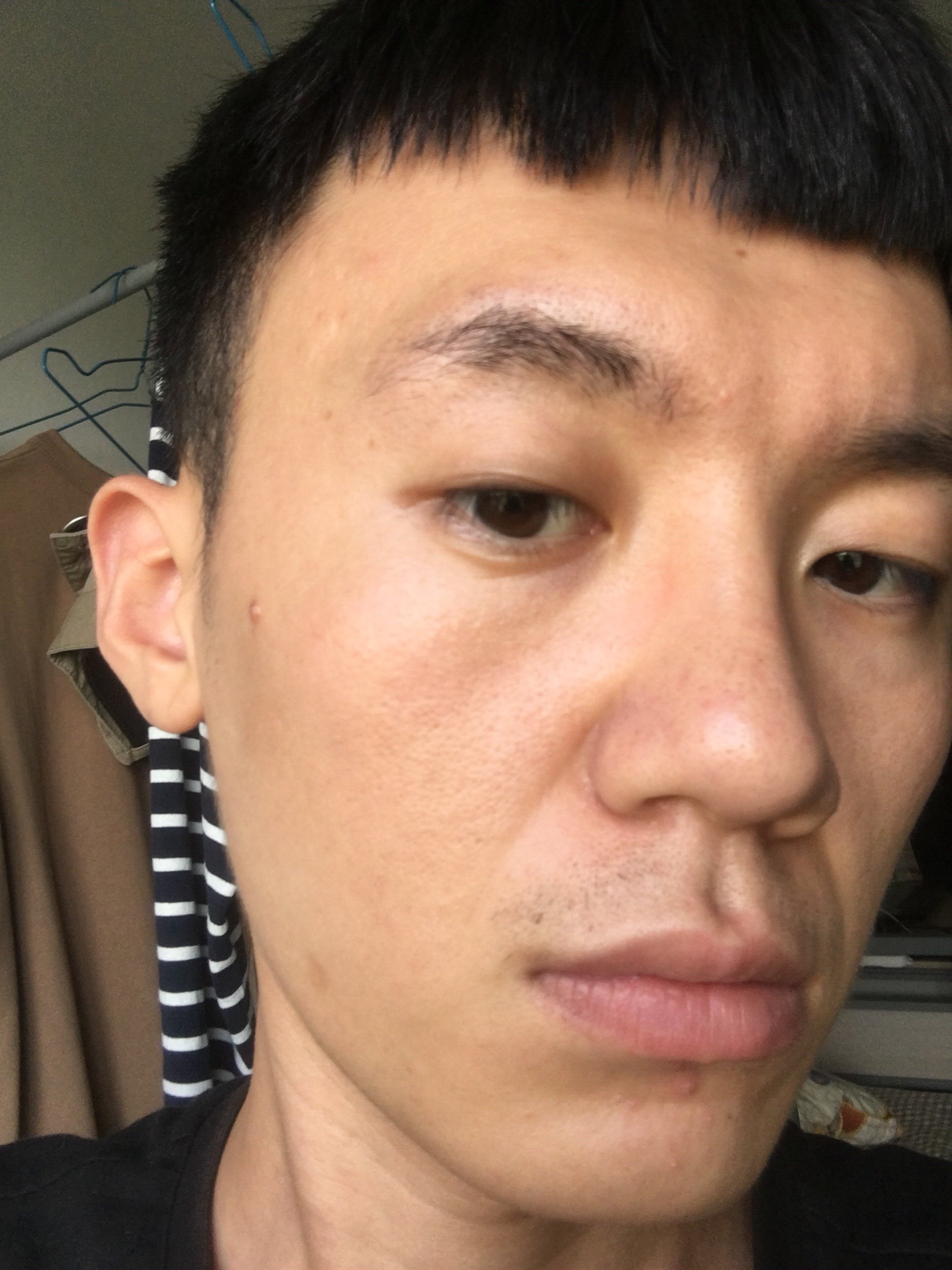 24岁,皮肤松弛老化严重,毛孔粗大,做什么项目可以有效解决