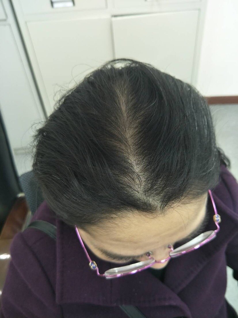 30岁女性脱发怎么办头顶已经开始漏头皮了需要植发吗植发后还会脱发吗
