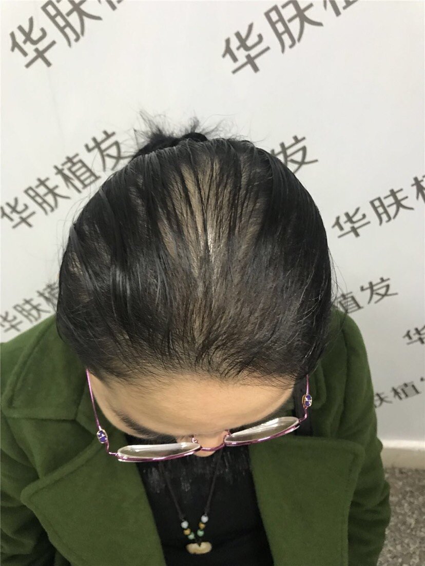 30岁女性脱发怎么办头顶已经开始漏头皮了需要植发吗植发后还会脱发吗