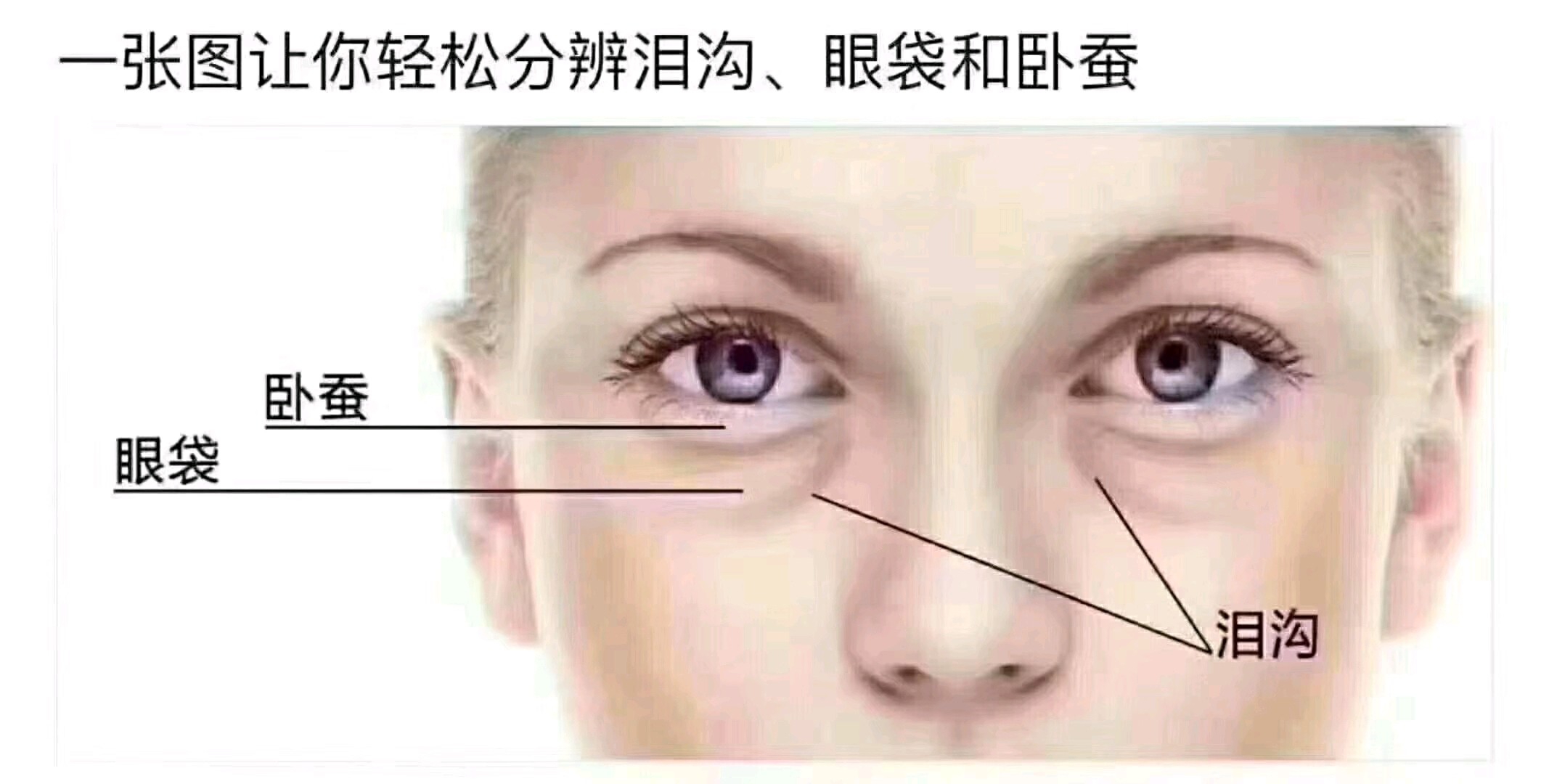 眼袋泪沟卧蚕黑眼圈要怎么区分
