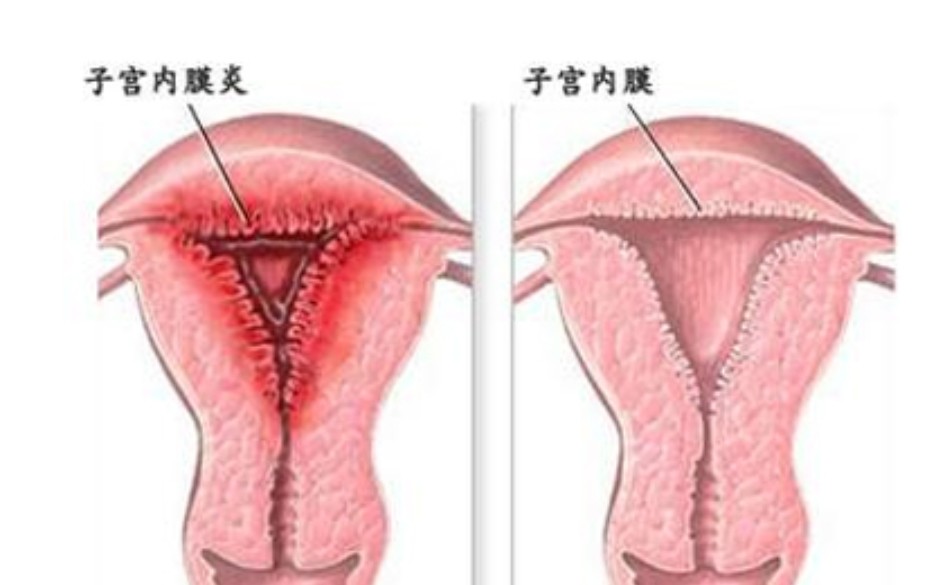 到底是什么原因会导致子宫内膜炎复发呢