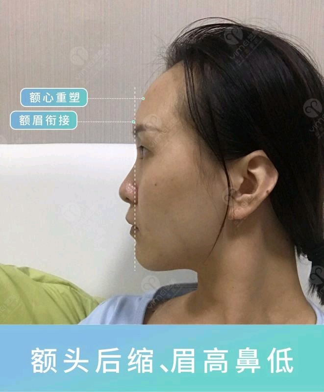 求看脸 脸歪嘴凸 肤色暗黄 22岁被叫 新氧美容整形