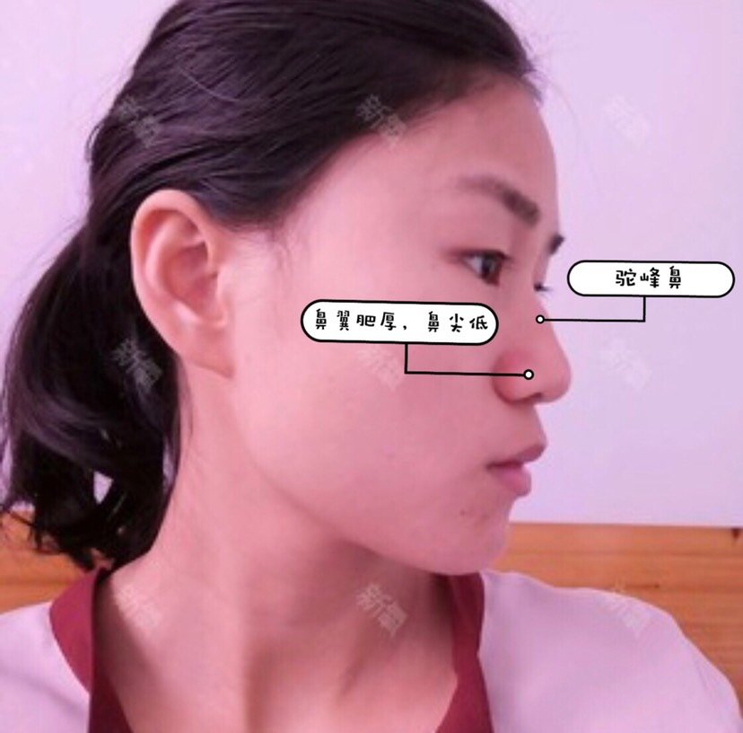 求看脸:头扁国字脸,面塌又凸嘴,能整成鞠婧祎吗?