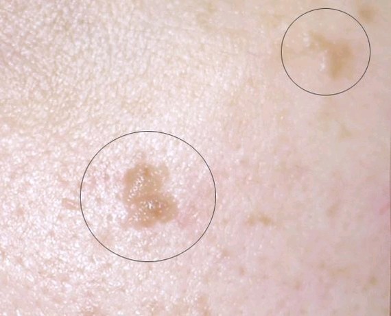 扁平疣是由人类乳头状瘤病毒(hpv)感染引起的一种皮肤病,临床