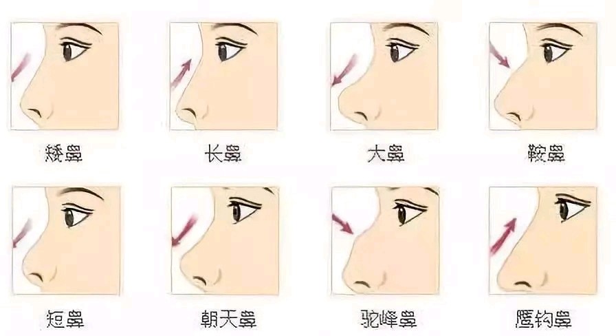 鼻部多项有哪些项目 新氧美容整形