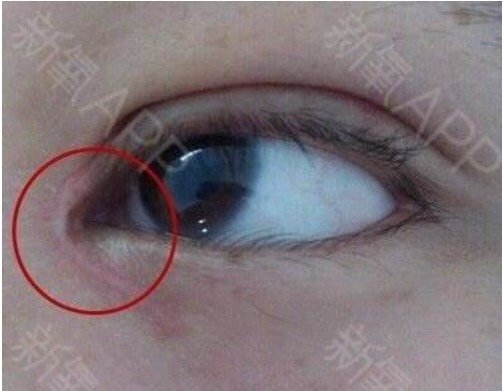 做过纳米埋线双眼皮,这个宽度正常吗?其他地方能怎么调整呢?