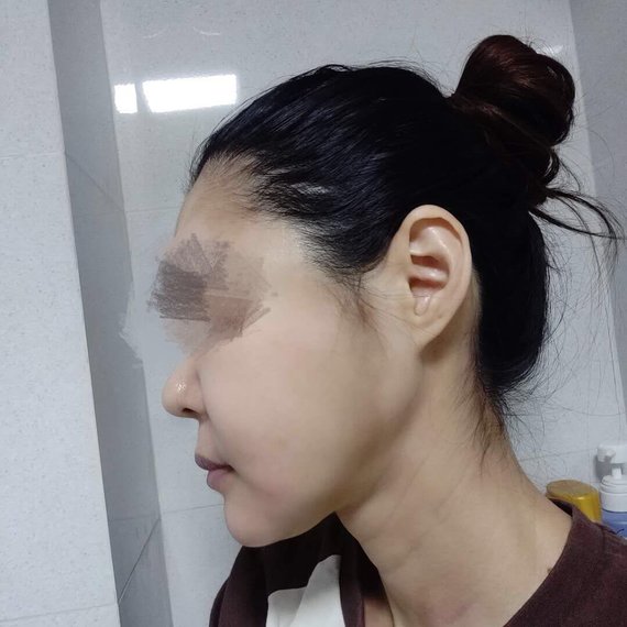 美女的下颌角都长一个样