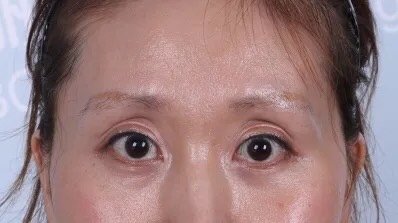 想问下大家有填上眼窝的效果如何维持多久有没有什么后遗症