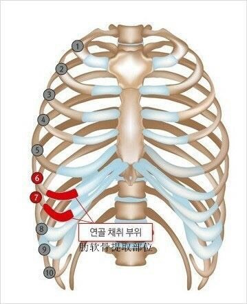 肋软骨一般取哪个肋骨 还是说随便都可 新氧美容整形