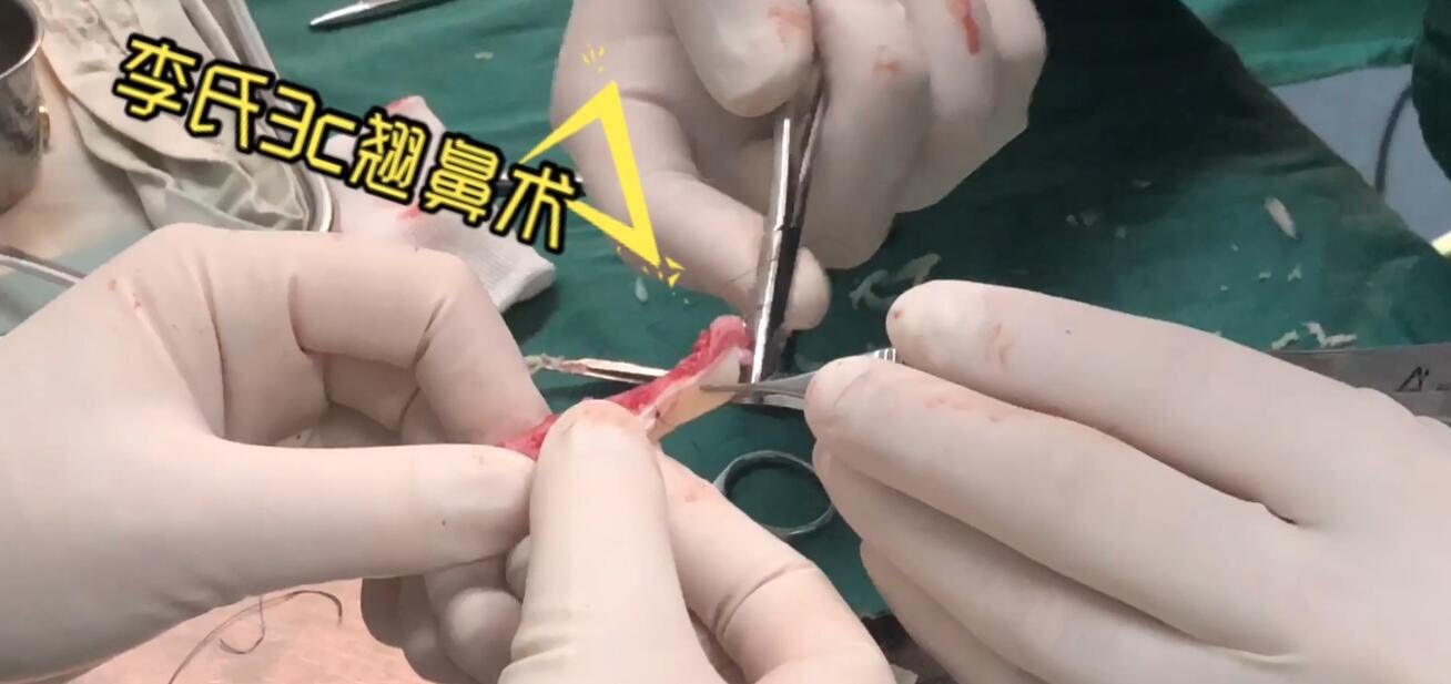 肋软骨一般取哪个肋骨还是说随便都可以