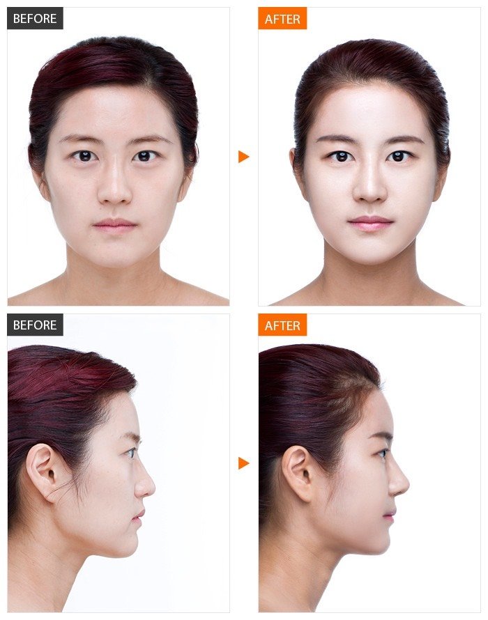 从小面部就凹陷,颧骨突出很奇怪,朋友推荐一起去做个自体脂肪填充