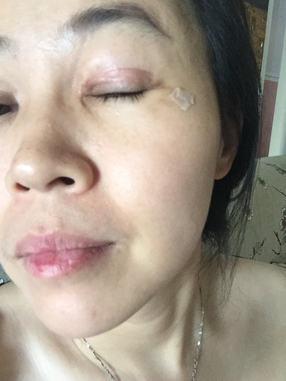 术后两周出现疤痕增生睁眼时眼周皮肤有牵拉感