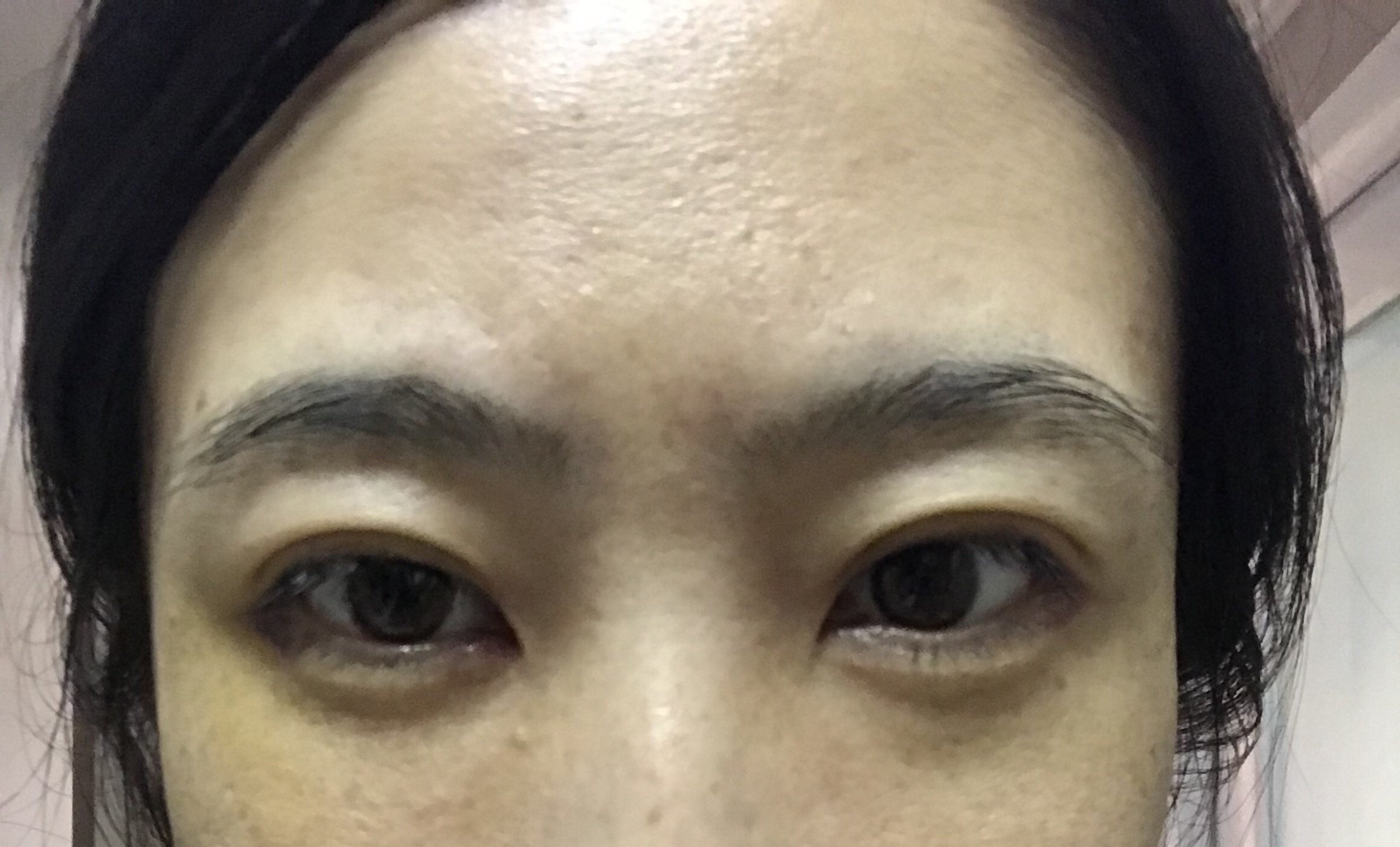 内切眼袋术后第七天 右眼一点眼袋没有 新氧美容整形