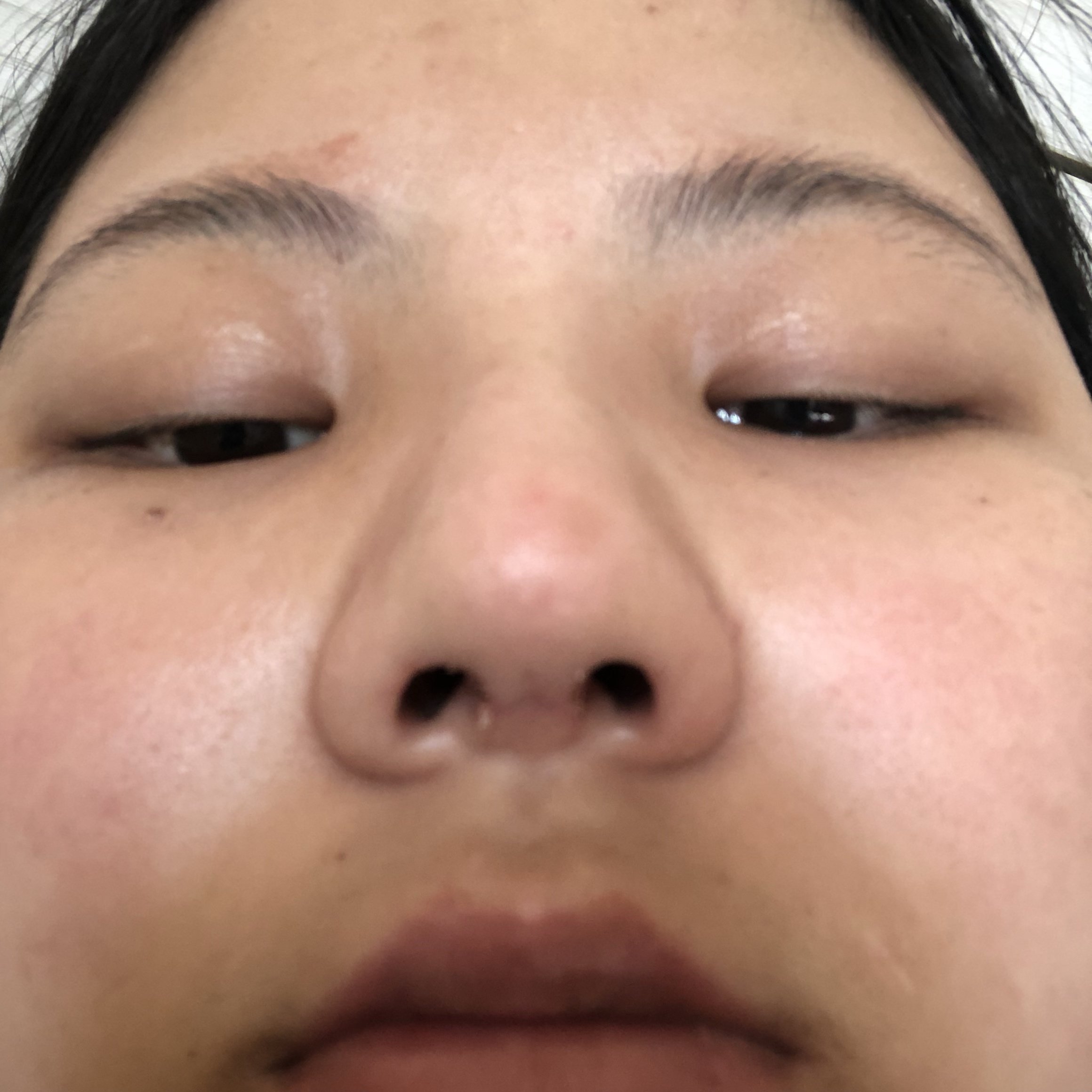 隆鼻14天我两边鼻翼好像不一样,是手术的原因还是没恢复好的原因啊?