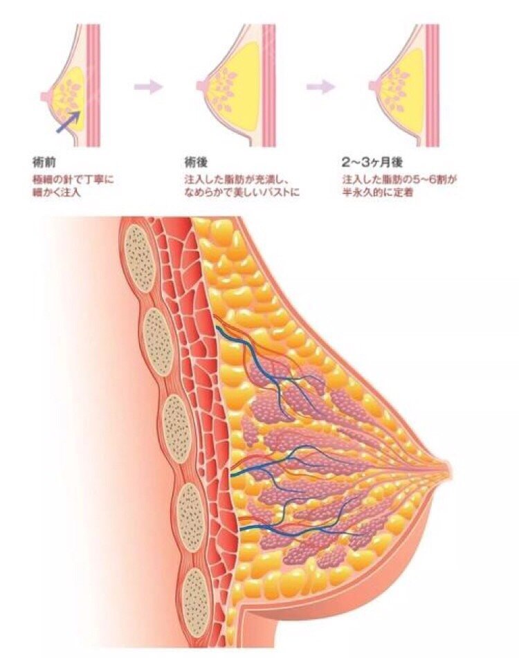 自体脂肪填充都能用来填充哪些部位 新氧美容整形