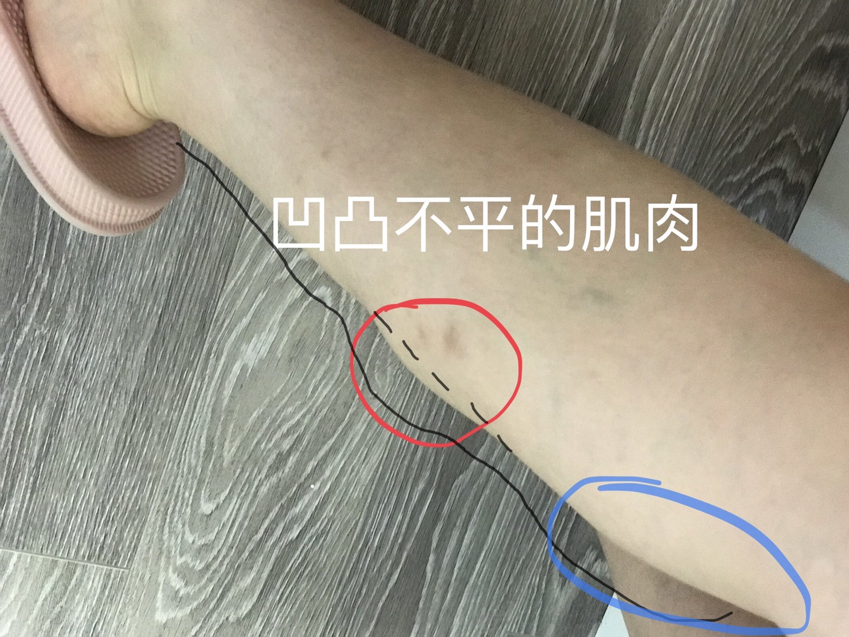 瘦腿针注射后为何会有腿部肌肉凹凸不平 新氧美容整形