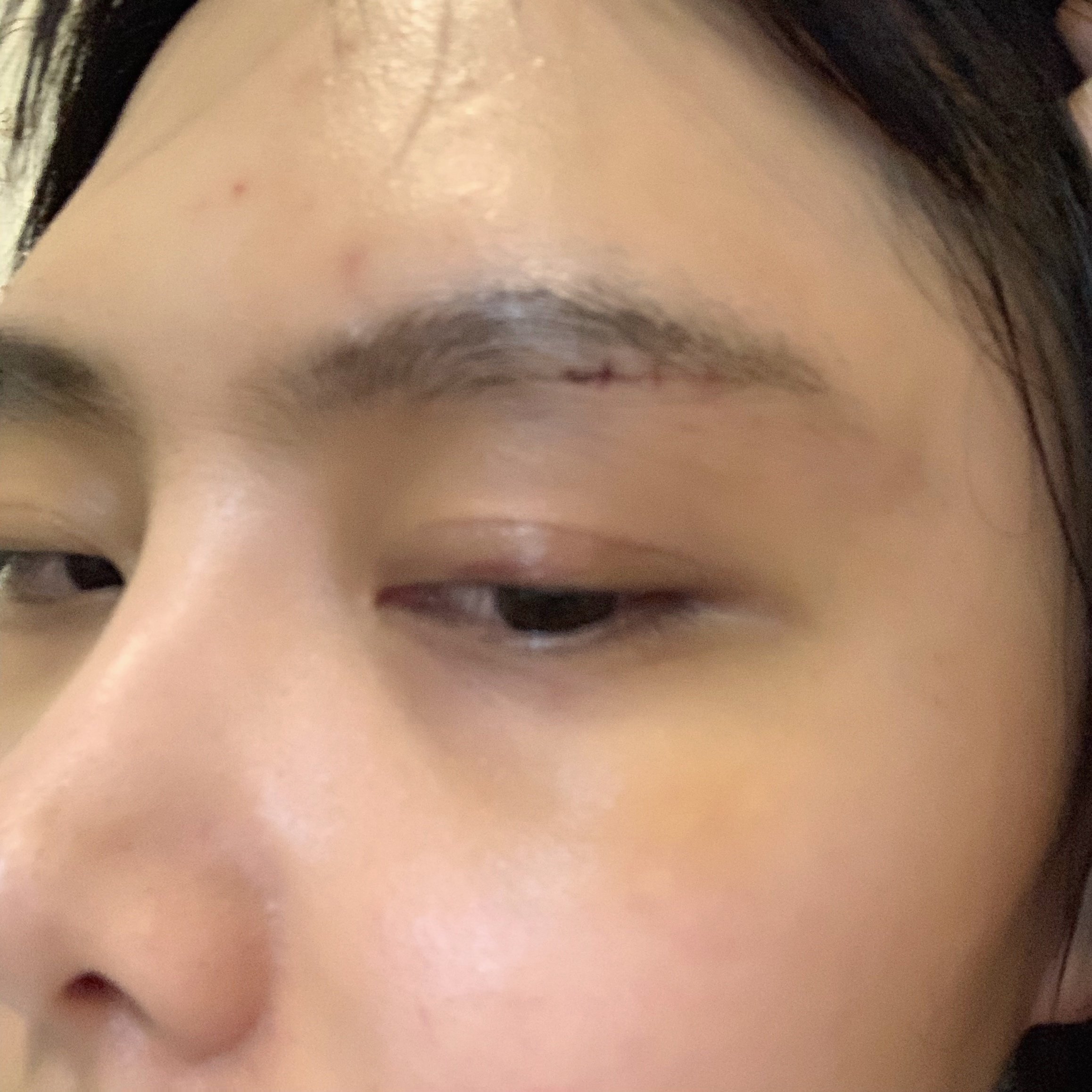 为什么我垫完眉骨后头皮和额头没有知觉 新氧美容整形
