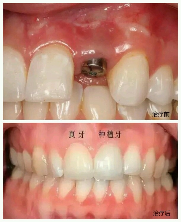 如果是镶牙种植牙与烤瓷牙的区别在哪里哪种的效果好维持的时间长而且