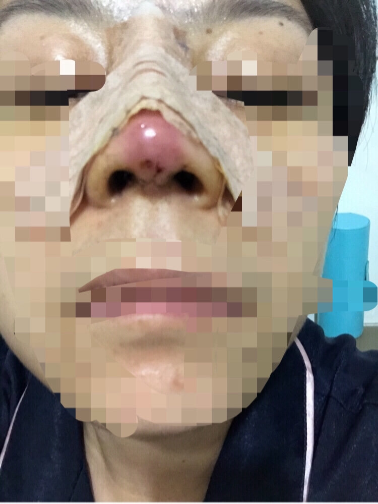 隆鼻鼻头红感染图片图片