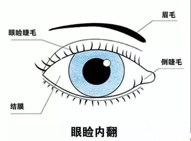 痙攣 下 瞼