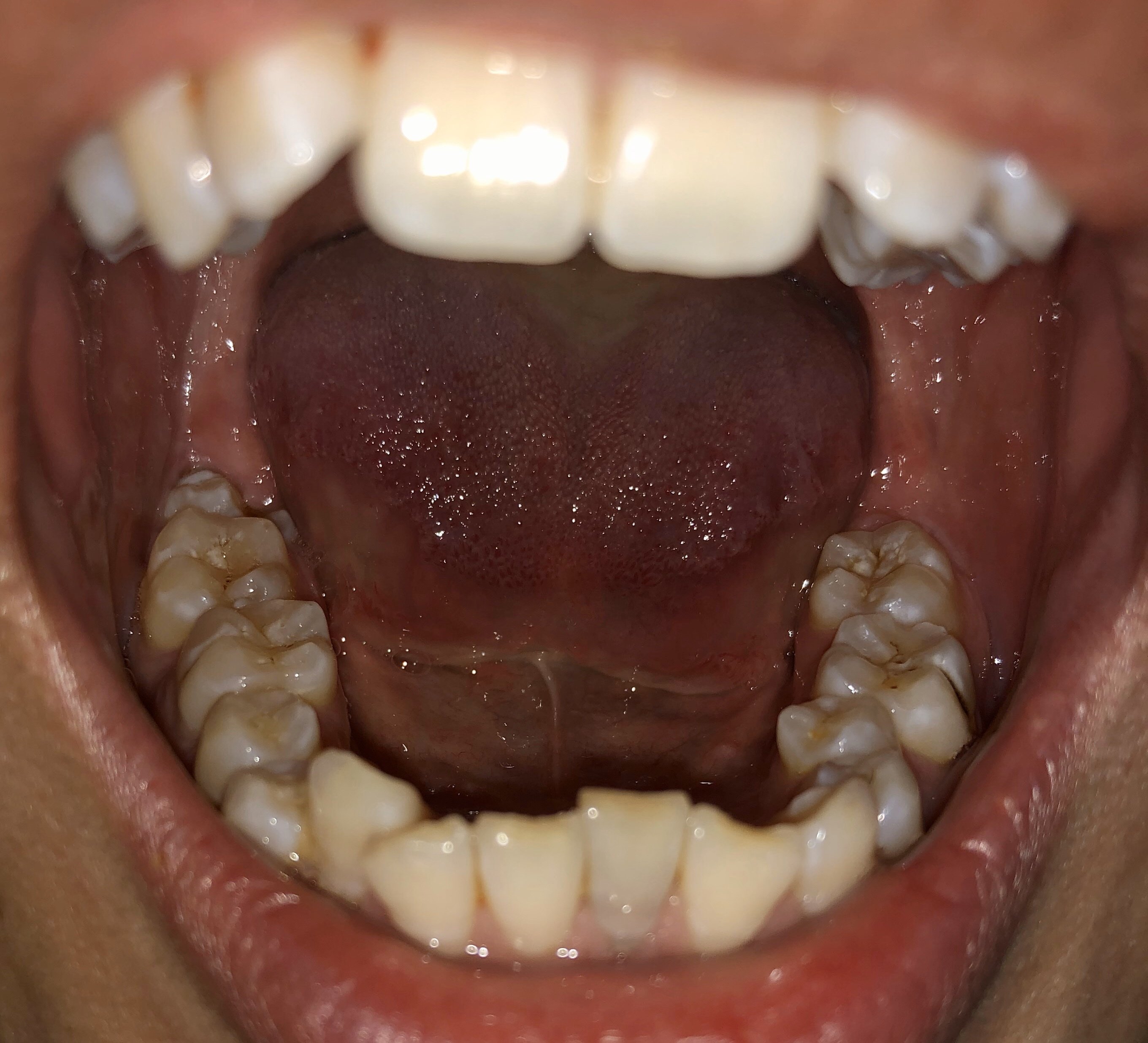 牙齿不齐,咬合也有毛病,我嘴歪,脸不对称会不会跟这有关