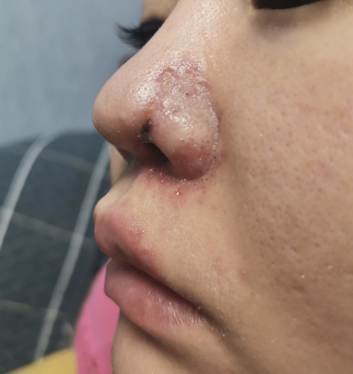 玻尿酸注射鼻基底和法令纹导致栓塞感染到鼻子注射溶解酶后鼻子结痂