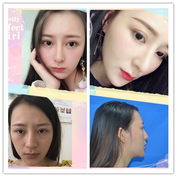 歪鼻不好看要怎么矫正 矫正后效果怎么 新氧美容整形