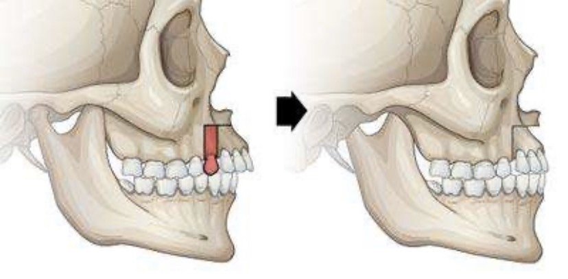 牙槽骨突出有解决的办法吗