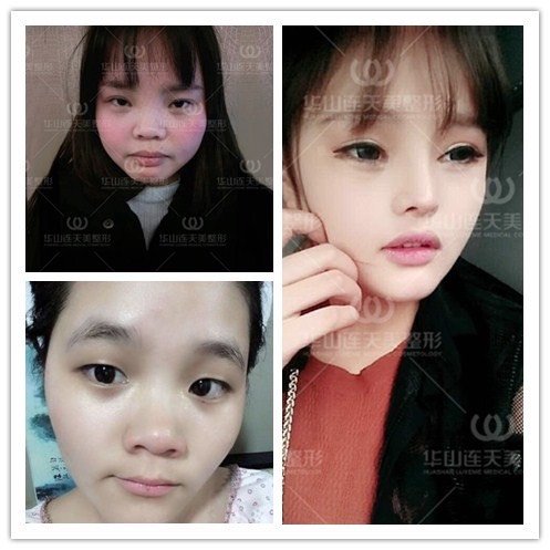我鼻翼是不是有点宽 想缩鼻翼 黑眼圈 新氧美容整形