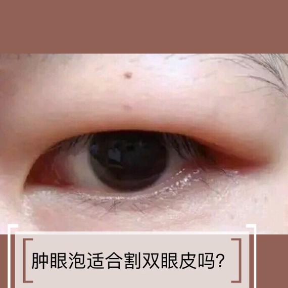 肿眼泡适合做双眼皮吗?