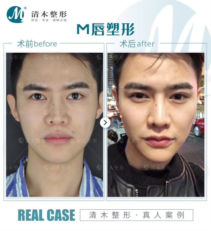 请问m唇手术前后需要休息什么呢