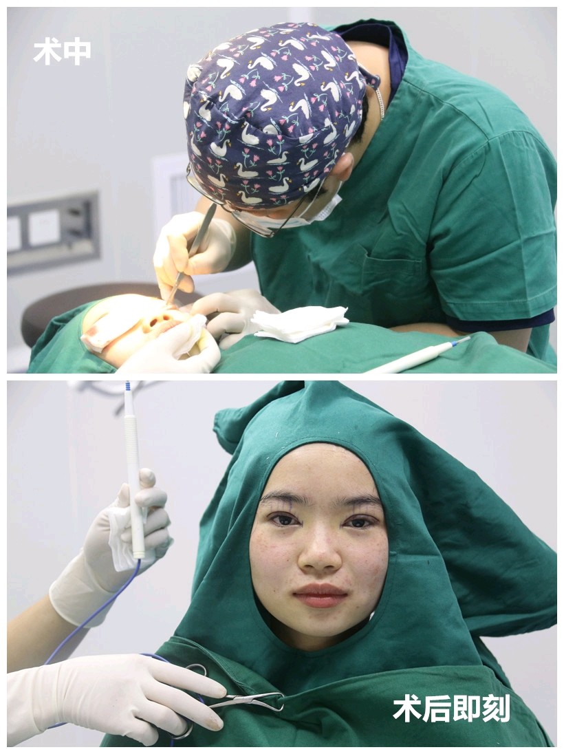 哪里做双眼皮手术最好？双眼皮手术效果如何？去上海割双眼皮